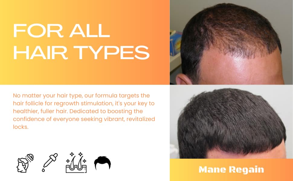 Minoxidil Topical Solution USP 5%, Extra Strength Hair Regrowth Treatment for Men, 3 Month Supply, Unscented, 6 Fl Oz (3 Pack)