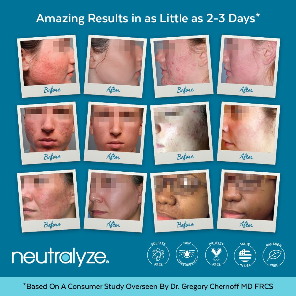 Moderate To Severe Acne Treatment Kit 2.0 - Maximum Strength Acne Kit, 2% Salicylic Acid, 2% Mandelic Acid & Nitrogen Boost Skincare Technology - Acne Treatment for Teens & Adults (90+ Day)