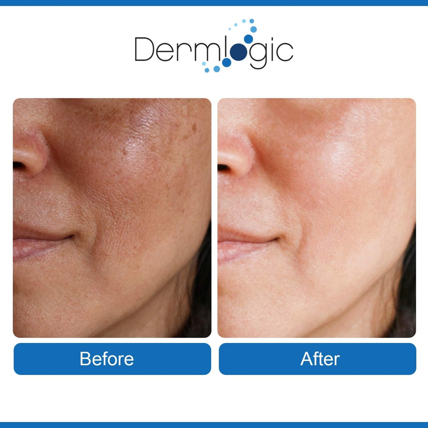 Anti Aging Resurfacing Peel Pads- Triple Action Chemical Peel Pads Combined with Glycolic, Lactic, and Salicylic Acids. Smooth’s Fine Lines, Wrinkles, Dark Spots, and Imperfections to Enhance the Skin