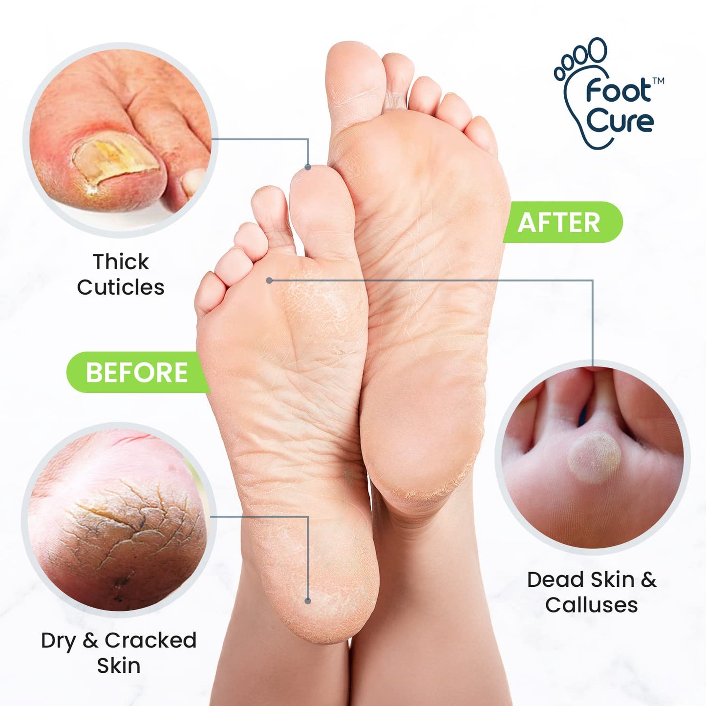 Tea Tree Foot Soak & Callus Remover Gel Kit - Extra Strength Callus Remover Gel & Foot Soak With Epsom Salts For Calluses, Dry Cracked Heels, Toenail - Pedicure for Tired Feet
