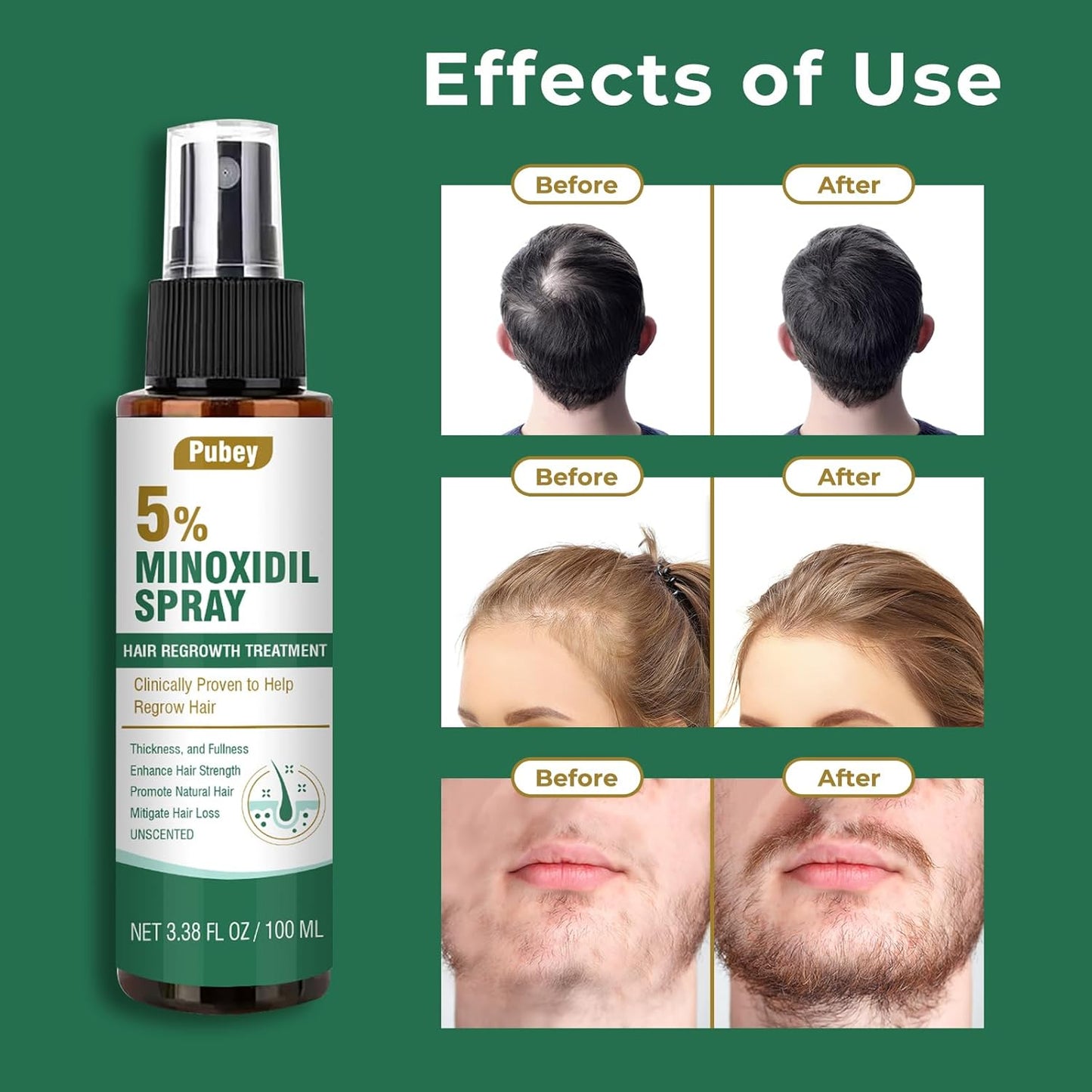 5% Minoxidil for Men, Minoxidil Spray for Women Hair Growth, Beard and Hair Growth Serum, Regrowth Treatment, 3.38 Fl Oz, 2 Month Supply