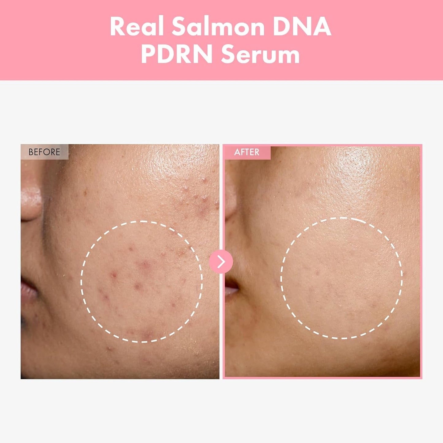Pink Peptide 12 PDRN Serum With Salmon DNA PDRN 10,320ppm, 12 Peptides, Niacinamide, Skin glow, Hydrating, Moisturizing, Firming, Uneven Skin Tone, Korean Skincare, 33ml, 1.11 fl.oz.